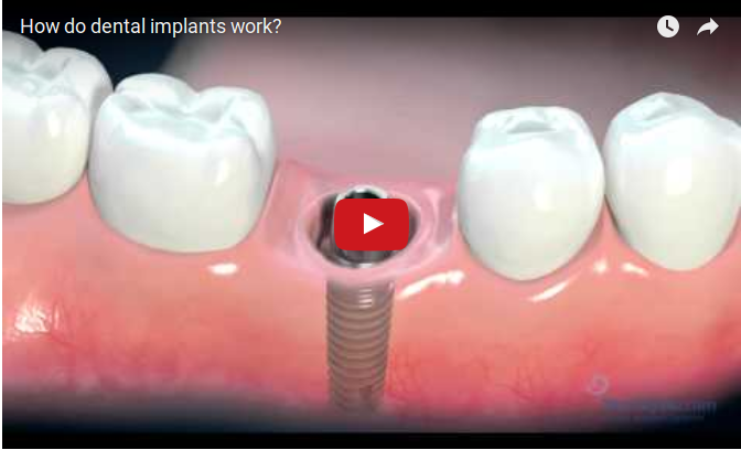 Πως ακριβώς λειτουργούν τα Εμφυτεύματα;